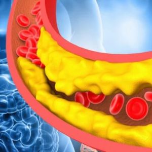 Hyperlipidemia